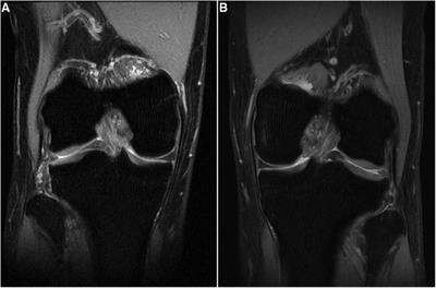 Case Report: Dislocation of lateral menisci secondary to congenital lateral tibiofemoral cartilage thickening in both knees